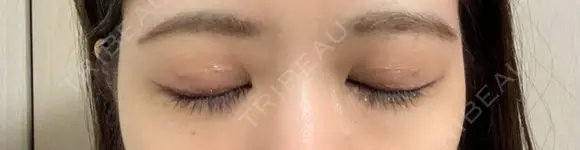 二重埋没 あきこクリニック DAY 28 メイン用