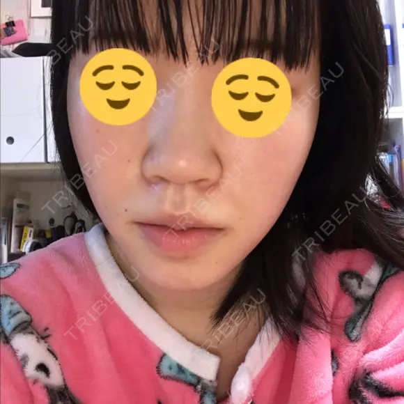 毛穴洗浄（ハイドラフェイシャルなど） 神成（こうせい）美容外科 DAY 9 メイン用