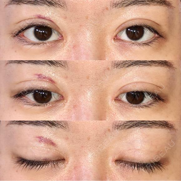 眼瞼下垂（切開） / その他（目元） / 目尻切開 / 自然癒着法 POP美容整形クリニック DAY 28 メイン用