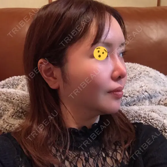 糸リフト / 骨切り（あご） / 骨削り（エラ） / 骨削り（頬） / 脂肪吸引（顔） / 輪郭修正 / 脂肪注入（額） / 脂肪注入（輪郭） / ハイフ（顔） GIRIN（ギリン）美容外科 DAY 116 メイン用