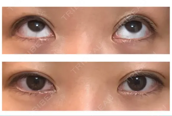 二重切開 / 上まぶたたるみ取り / 上まぶたの脂肪取り / 目元修正 リビジョンクリニック（旧：池本形成外科・美容外科） DAY 33 メイン用