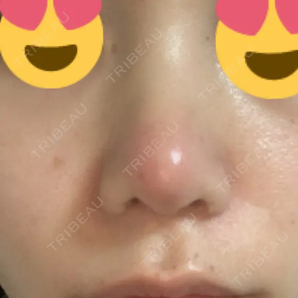 鼻尖形成（切開） / 鼻中隔延長（切開） / 小鼻縮小（切開） / 軟骨移植 HANABI整形外科 DAY 103 メイン用