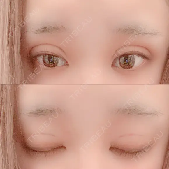 二重埋没 広島プルミエクリニック DAY 0 メイン用