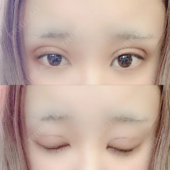 二重埋没 広島プルミエクリニック DAY 1 メイン用