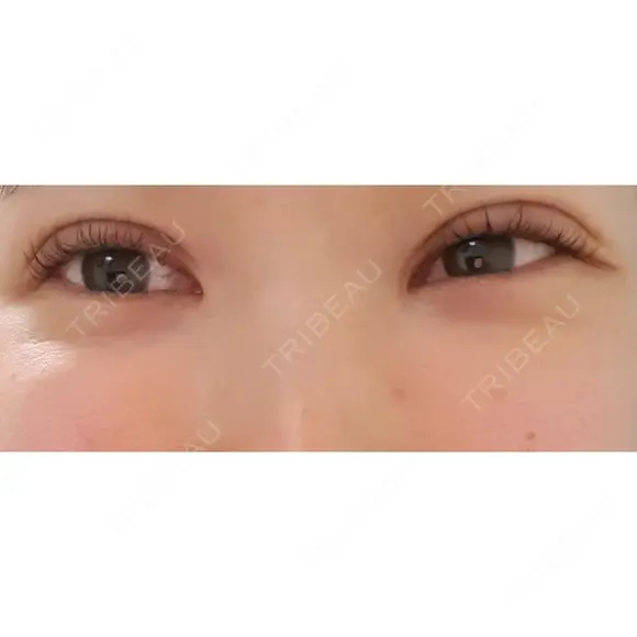 二重切開 CLASSY 仙台美容外科・美容皮膚科 DAY 43 メイン用