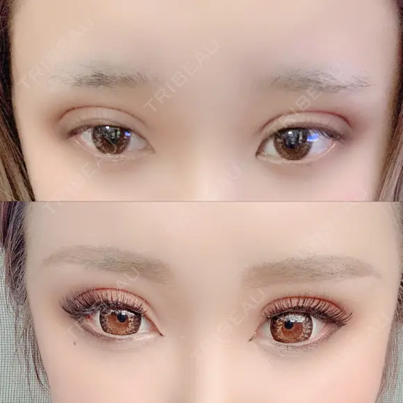 二重埋没 広島プルミエクリニック DAY 2 メイン用