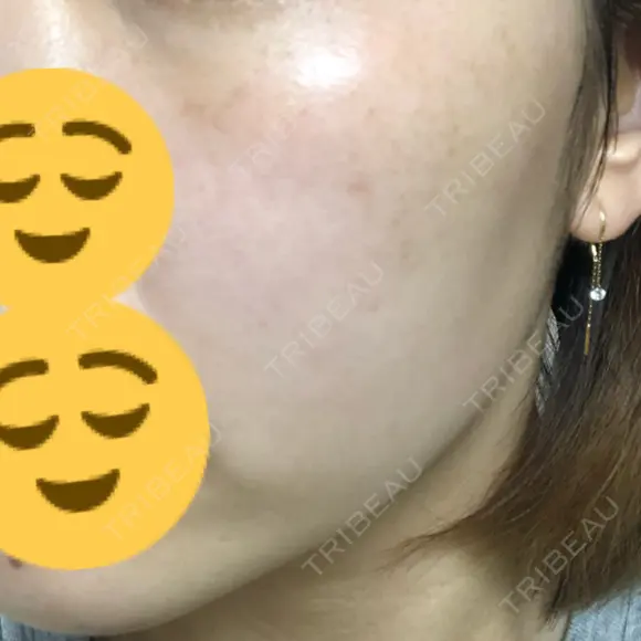 ニキビ治療 / 美肌レーザー / シミ取りレーザー UB CLINIC 銀座 DAY 28 メイン用