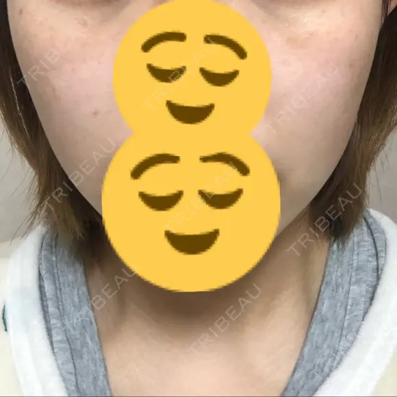 ニキビ治療 / 美肌レーザー / シミ取りレーザー UB CLINIC 銀座 DAY 28 メイン用