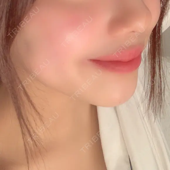 脂肪溶解注射（顔） クリニックA.O. AFTER メイン用