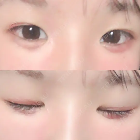 その他（目元） ばん皮膚科 DAY 11 メイン用