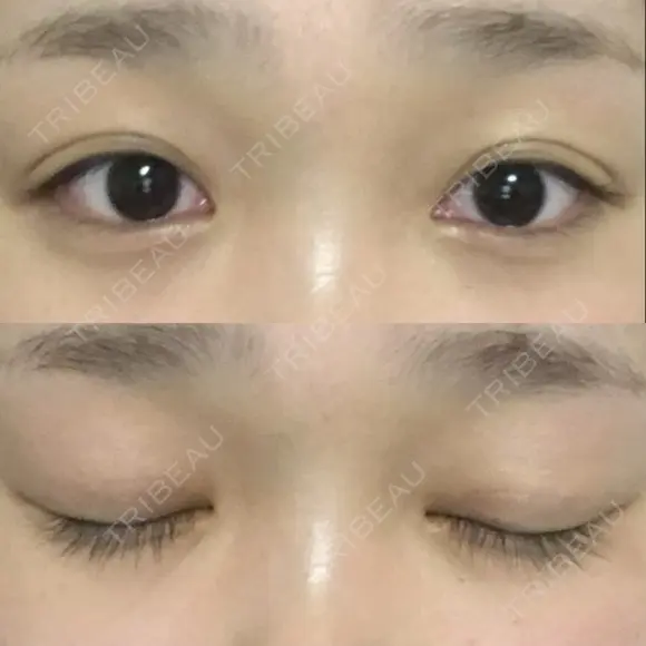 二重埋没 湘南美容クリニック 福島院 DAY 31 メイン用