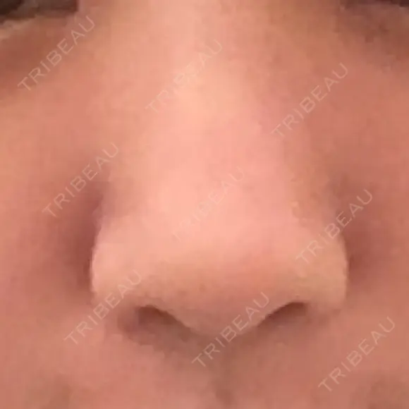 小鼻縮小（切開） 東京ヒルズクリニック 新宿院 AFTER メイン用