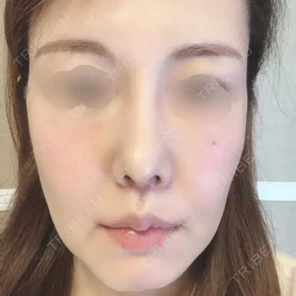 人中短縮 / 口角挙上 清潭女神美容外科 AFTER メイン用