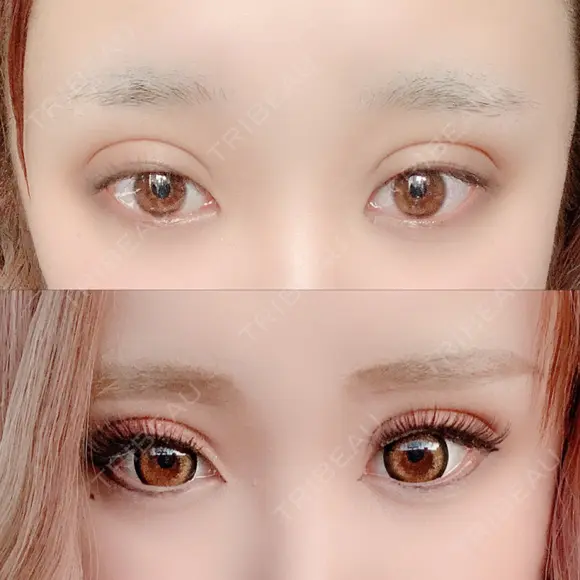 二重埋没 広島プルミエクリニック DAY 3 メイン用