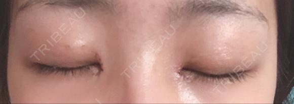 二重埋没 / 目頭切開 アロマ美容外科クリニック DAY 1 メイン用