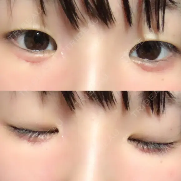 その他（目元） ばん皮膚科 DAY 12 メイン用