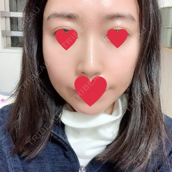 骨削り（頬） / 輪郭修正 マックスファクス銀座クリニック DAY 190 メイン用