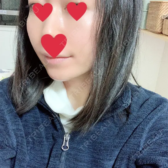 骨削り（頬） / 輪郭修正 マックスファクス銀座クリニック DAY 190 メイン用