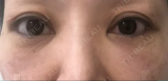 下まぶたたるみ取り セオリークリニック DAY 0 メイン用