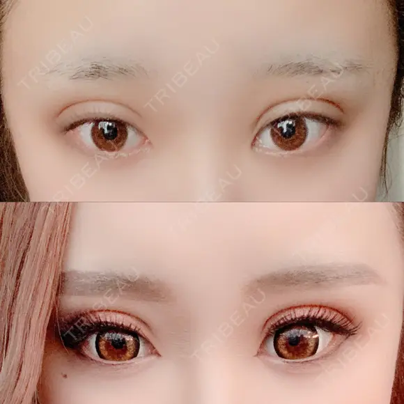 二重埋没 広島プルミエクリニック DAY 4 メイン用