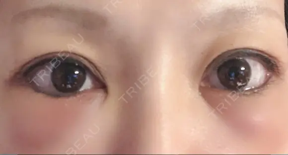 下まぶたたるみ取り セオリークリニック DAY 1 メイン用