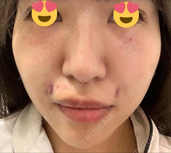 PRP皮膚再生療法 聖心美容クリニック 名古屋院 AFTER メイン用
