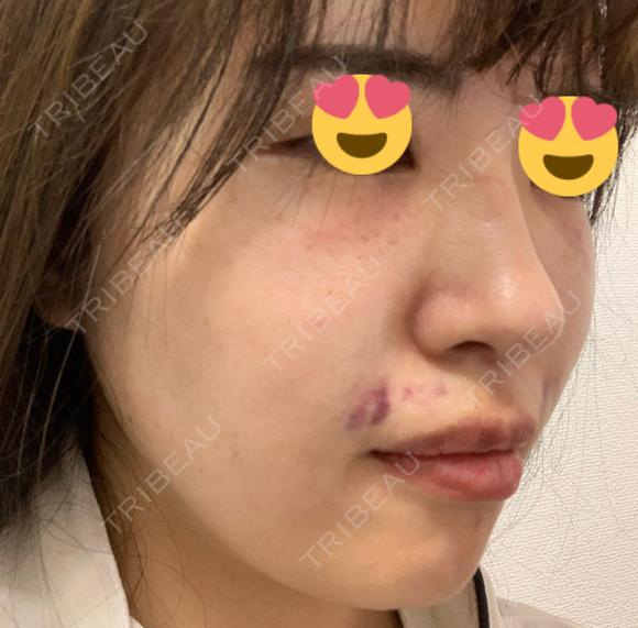 PRP皮膚再生療法 聖心美容クリニック 名古屋院 DAY 1 メイン用