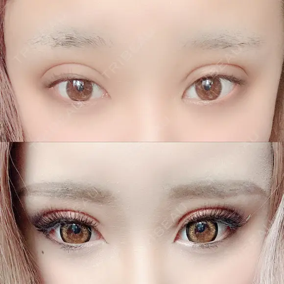 二重埋没 広島プルミエクリニック AFTER メイン用