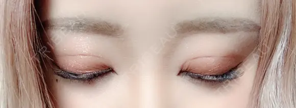 二重埋没 広島プルミエクリニック DAY 5 メイン用