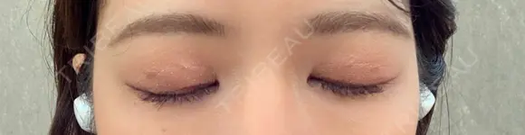 二重埋没 あきこクリニック DAY 37 メイン用
