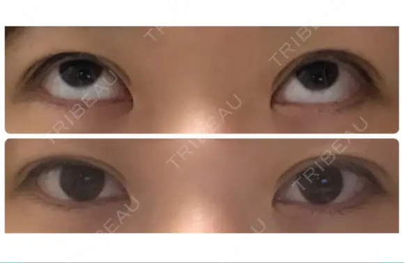 二重切開 / 上まぶたたるみ取り / 上まぶたの脂肪取り / 目元修正 リビジョンクリニック（旧：池本形成外科・美容外科） DAY 40 メイン用