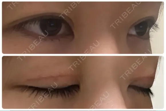 二重切開 / 上まぶたたるみ取り / 上まぶたの脂肪取り / 目元修正 リビジョンクリニック（旧：池本形成外科・美容外科） DAY 40 メイン用