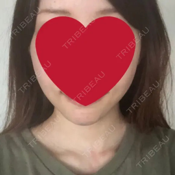 骨切り（あご） / 骨削り（エラ） / 脂肪注入（輪郭） RG整形外科（旧リオン整形外科） DAY 31 メイン用