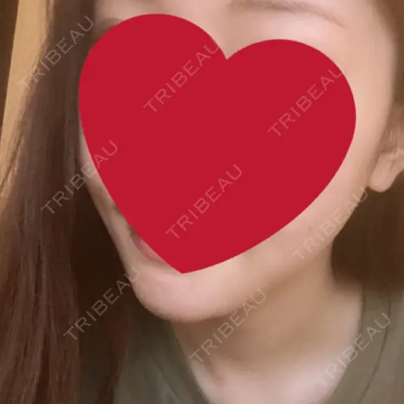 骨切り（あご） / 骨削り（エラ） / 脂肪注入（輪郭） RG整形外科（旧リオン整形外科） DAY 31 メイン用