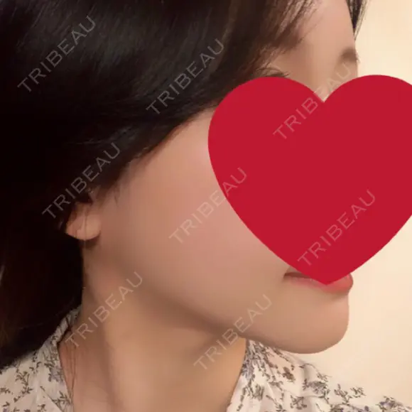 骨切り（あご） / 骨削り（エラ） / 脂肪注入（輪郭） RG整形外科（旧リオン整形外科） DAY 96 メイン用