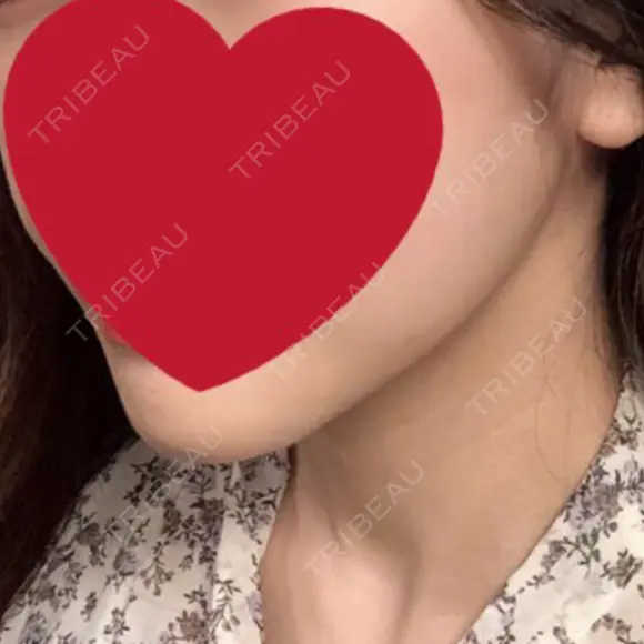 骨切り（あご） / 骨削り（エラ） / 脂肪注入（輪郭） RG整形外科（旧リオン整形外科） DAY 96 メイン用