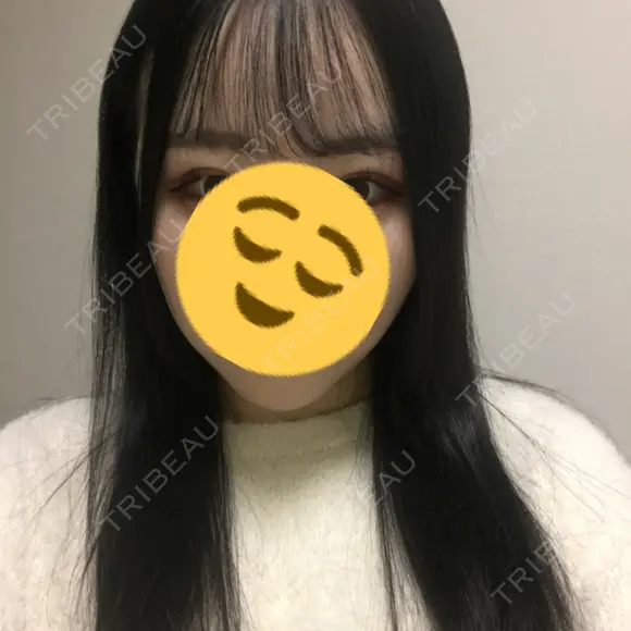 バッカルファット除去 / 脂肪吸引（顔） / ボトックス（エラ・小顔） / ヒアルロン酸注入（額） エートップ美容整形外科 AFTER メイン用