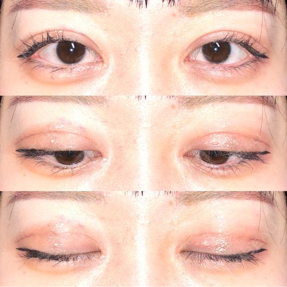 眼瞼下垂（切開） / その他（目元） / 目尻切開 / 自然癒着法 POP美容整形クリニック DAY 36 メイン用