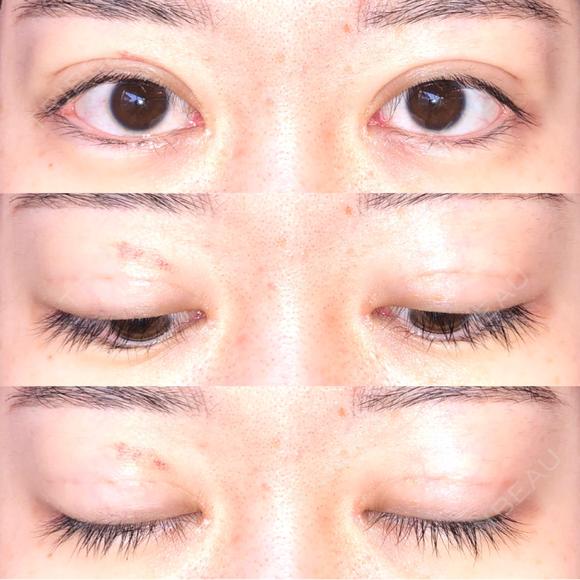 眼瞼下垂（切開） / その他（目元） / 目尻切開 / 自然癒着法 POP美容整形クリニック DAY 36 メイン用