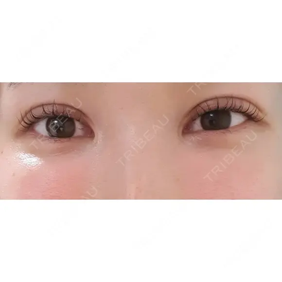 二重切開 CLASSY 仙台美容外科・美容皮膚科 DAY 47 メイン用