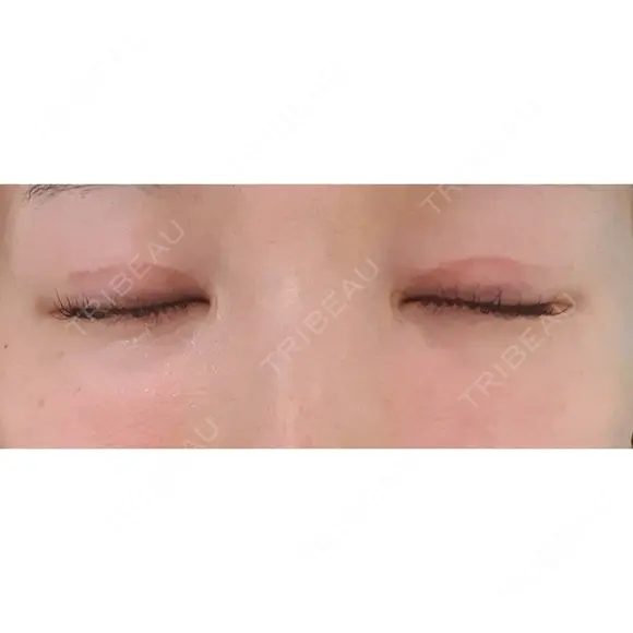 二重切開 CLASSY 仙台美容外科・美容皮膚科 DAY 47 メイン用