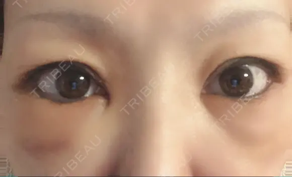 下まぶたたるみ取り セオリークリニック DAY 3 メイン用