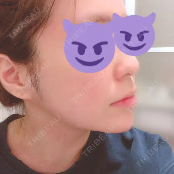 骨切り（あご） / 骨削り（エラ） / その他（輪郭） / 輪郭修正 RG整形外科（旧リオン整形外科） DAY 130 メイン用
