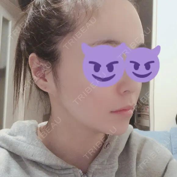 骨切り（あご） / 骨削り（エラ） / その他（輪郭） / 輪郭修正 RG整形外科（旧リオン整形外科） DAY 353 メイン用