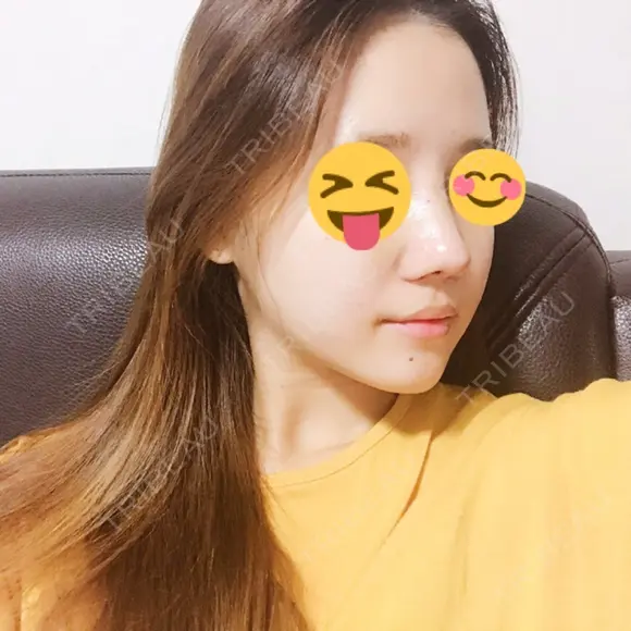 隆鼻術 / 鼻尖形成（切開） / 鼻中隔延長（切開） / 鼻孔縁挙上 ソウルリスタ整形外科 DAY 6 メイン用