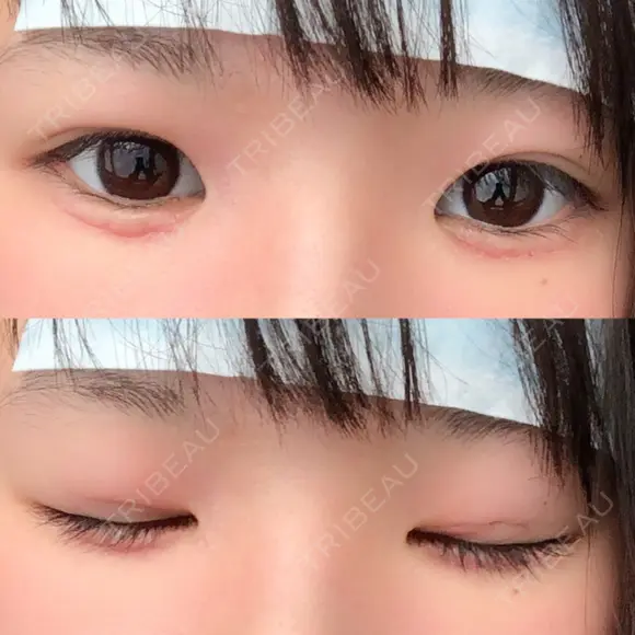 その他（目元） ばん皮膚科 AFTER メイン用