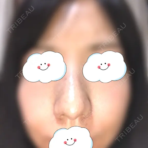 鼻尖形成（切開） / 軟骨移植 白山クリニック 大分 DAY 21 メイン用