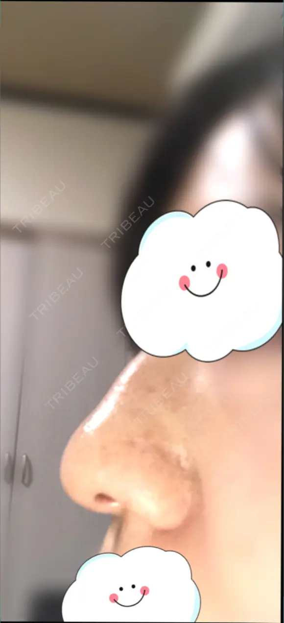 鼻尖形成（切開） / 軟骨移植 白山クリニック 大分 DAY 21 メイン用