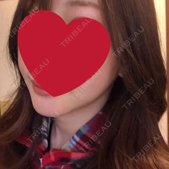 骨切り（あご） / 骨削り（エラ） / 脂肪注入（輪郭） RG整形外科（旧リオン整形外科） DAY 176 メイン用