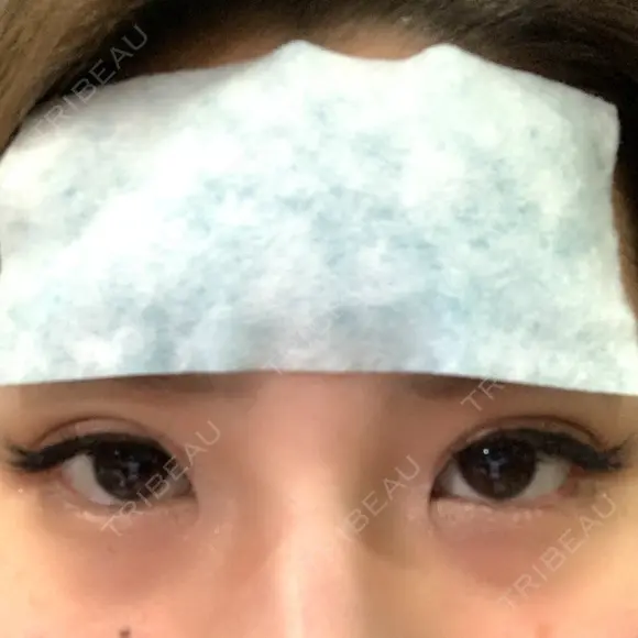 二重埋没 湘南美容歯科 大阪心斎橋院 DAY 0 メイン用